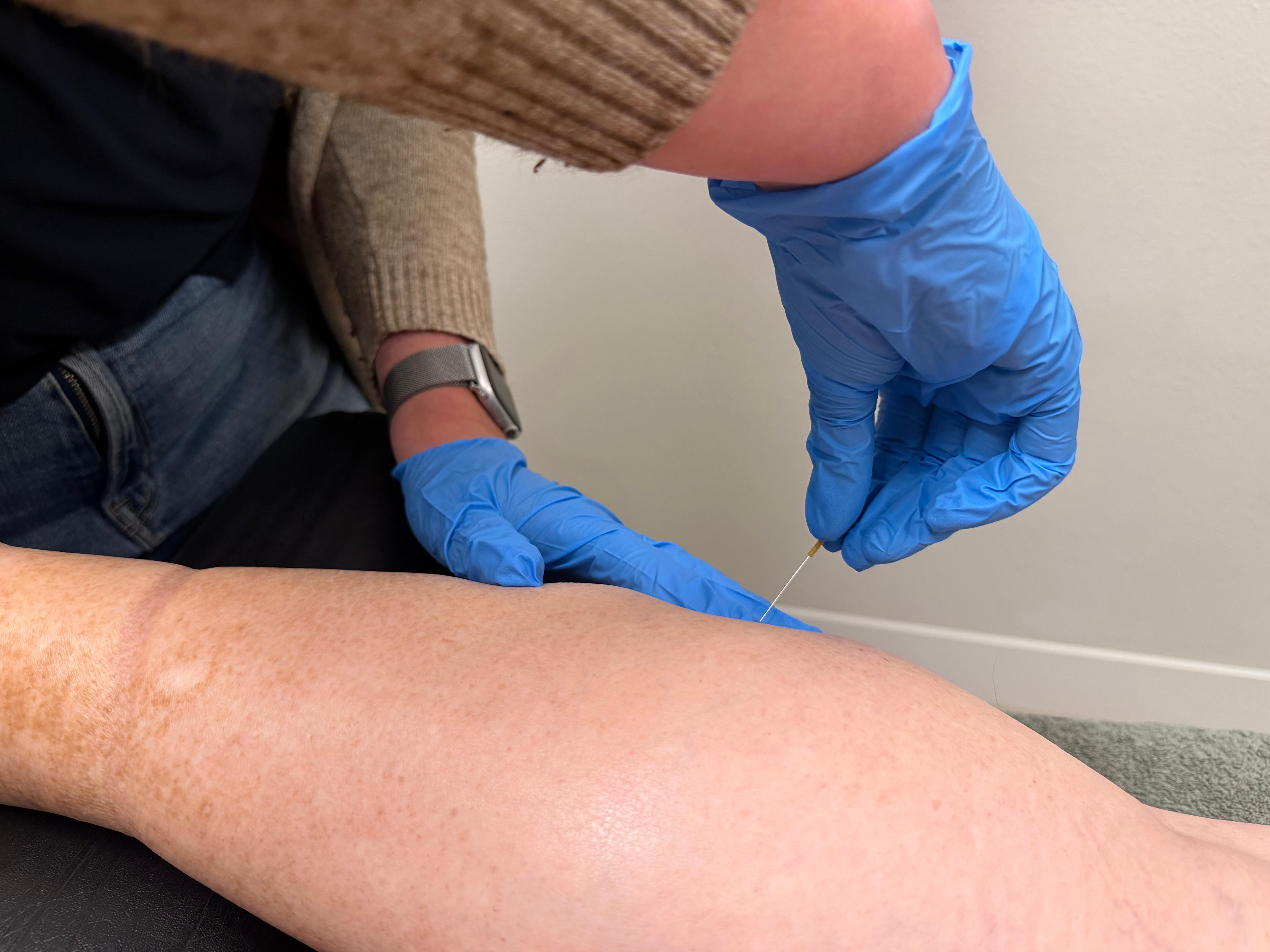 Dry Needling