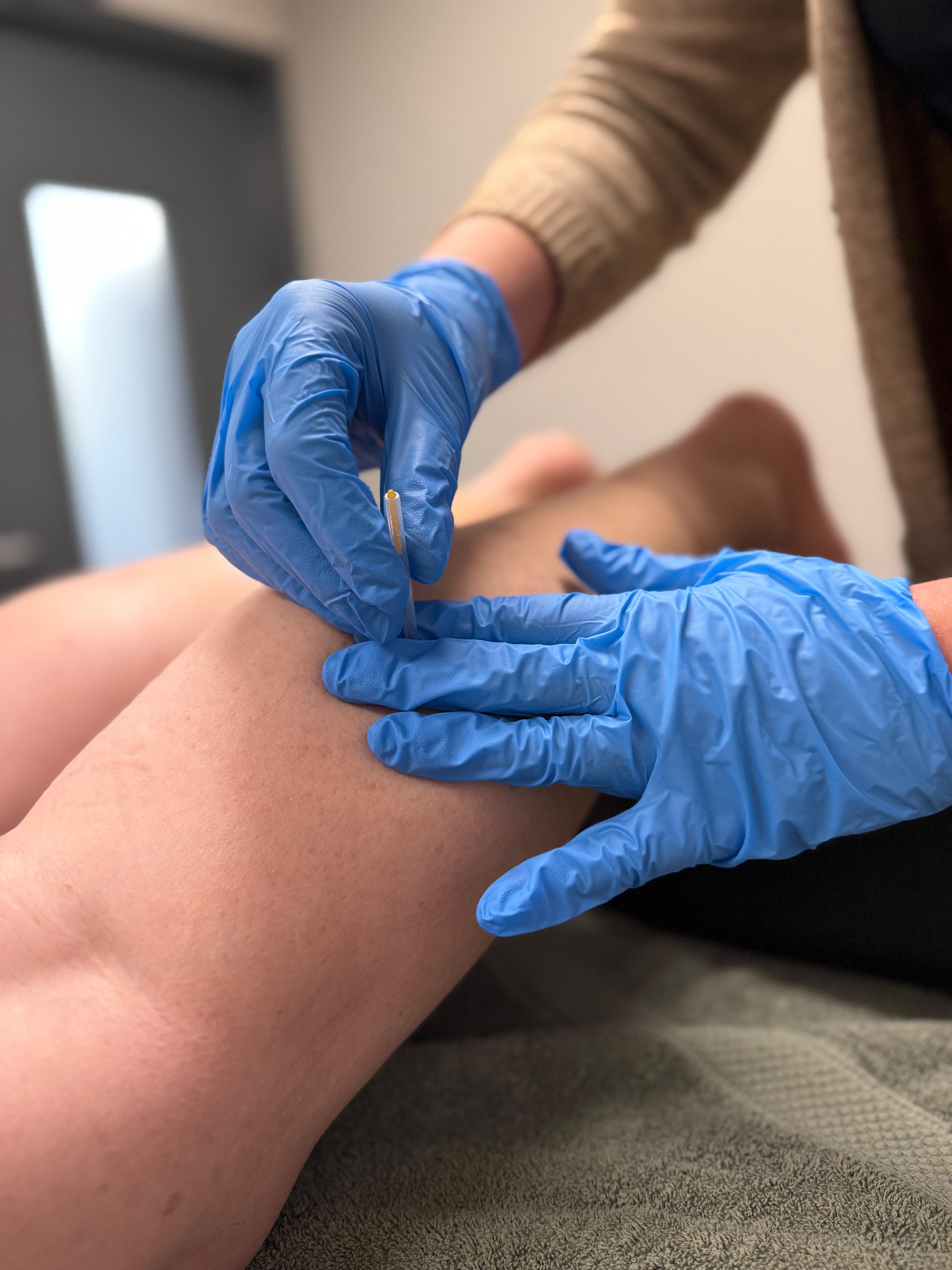 Dry Needling